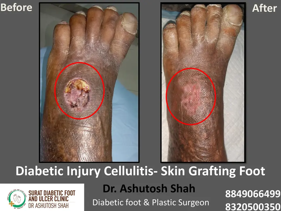 Diabetic Cellulitis and Coverage.pptx-12.webp